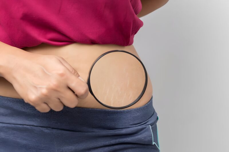 Ini 6 Cara Mengatasi Stretch Mark pada Tubuh